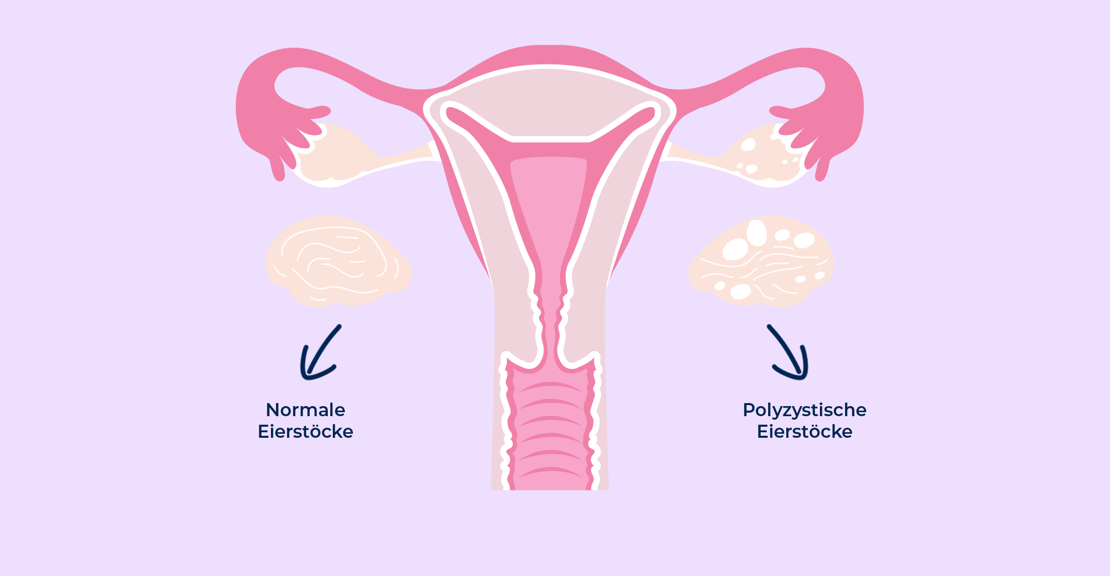 PCOS, PCO Syndrom, Eibläschen, Polyzystischen Ovarsyndroms