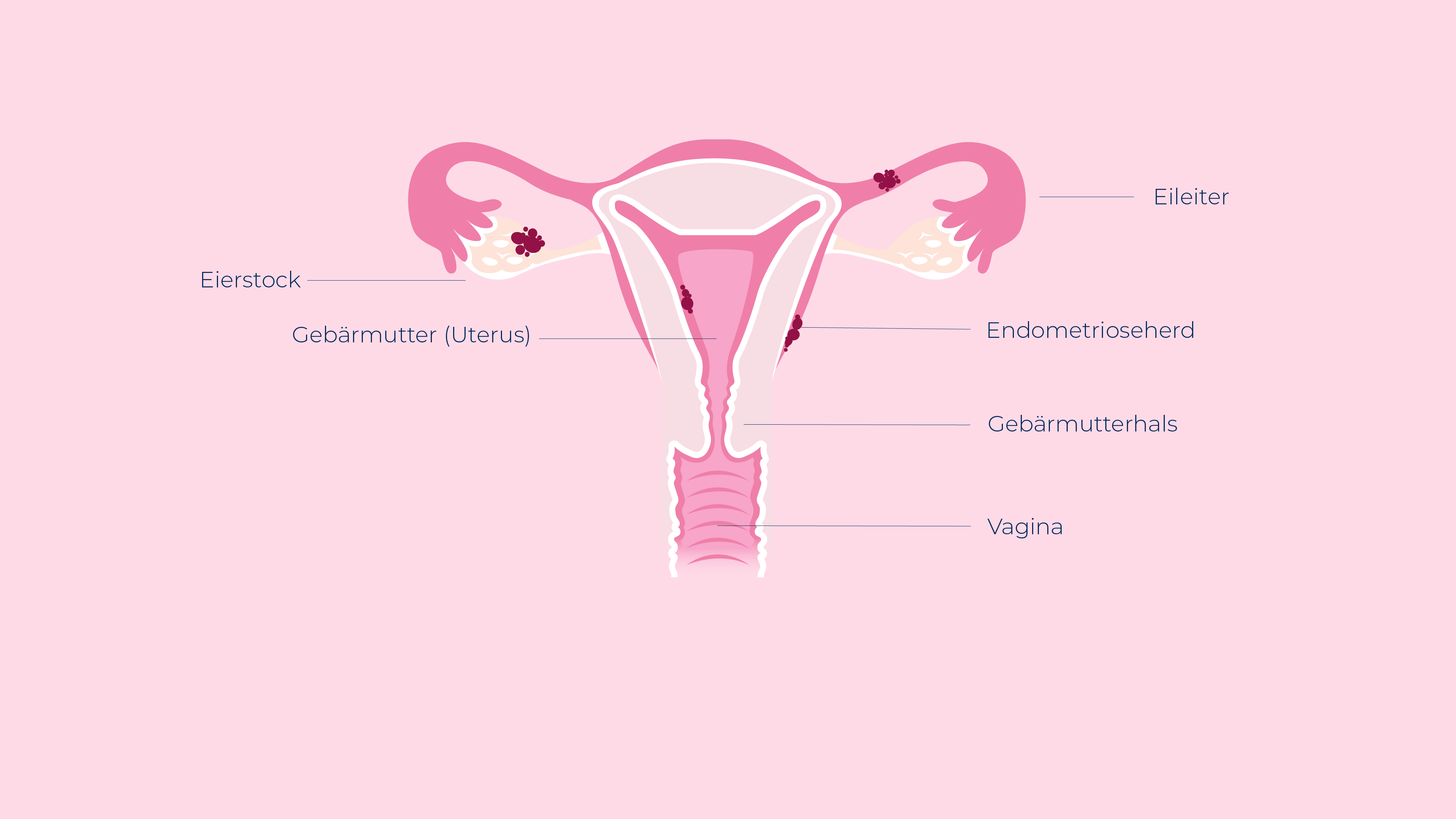 Uterus Gebärmutter mit Endometriose Endometrioseherde Endo Krankheit Natürliche Heilmethoden